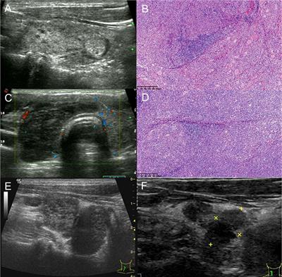 The usefulness of serial ultrasound in thyroid mucosa-associated lymphoid tissue lymphoma